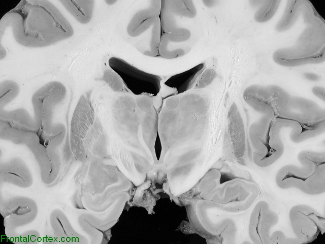 Normal Coronal Cut Through the Thalamus